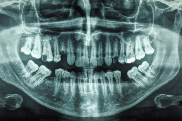Dental X-ray of a human mouth