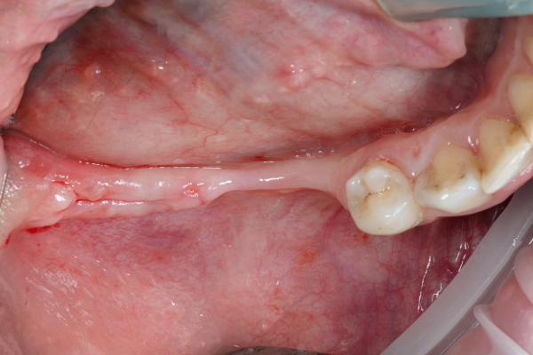 The inside lower jaw with bone loss.