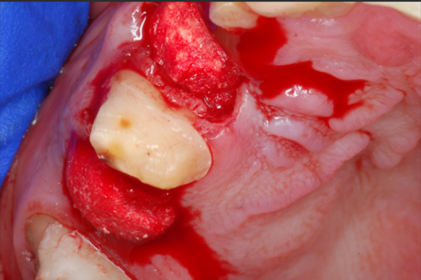 A jaw after bone grafting surgery.