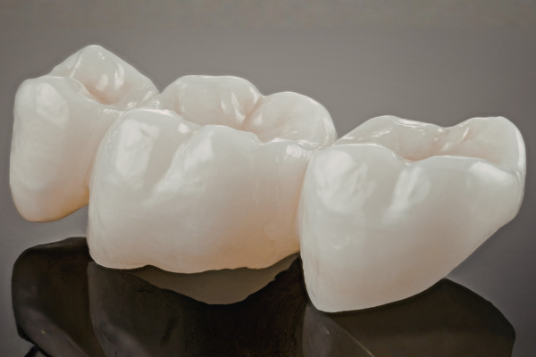 A fixed dental bridge before placement.