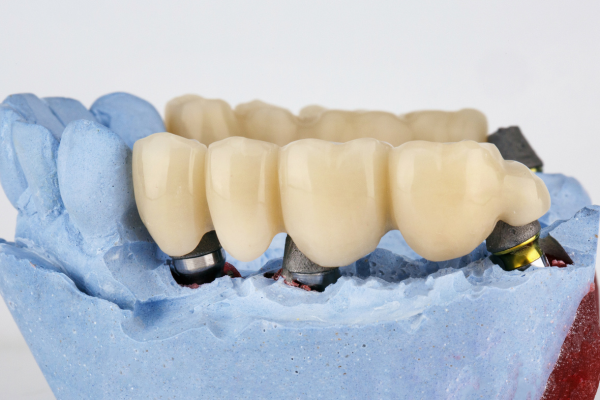 An implant dental bridge on a dental model.