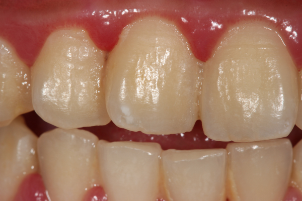 The early stages of periodontal disease with red gums and hardened plaque on the teeth.