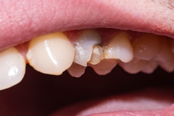 A close-up view of a chipped and damaged tooth.