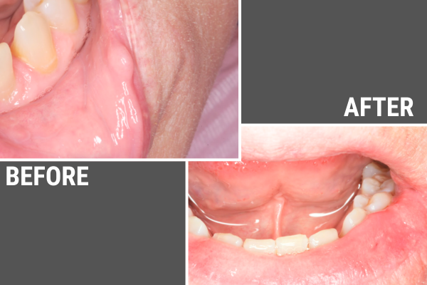 Before and after photos of a dental growth removed by JA Haselhorst, Naperville Dentist.