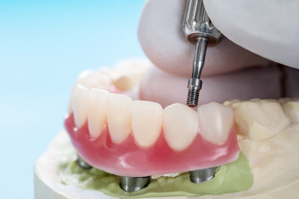 Implant-supported dentures in Naperville, IL.