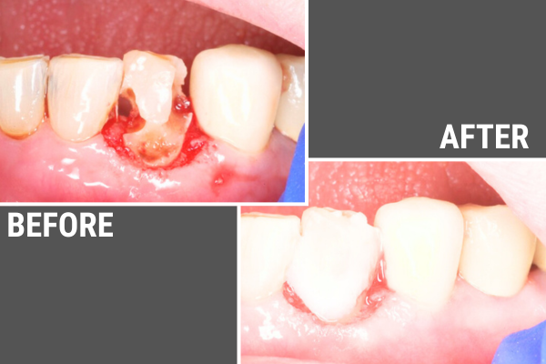 Before and after of an infected tooth being restored with a laser surgery and filling.