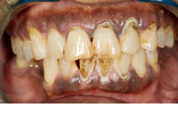 Advanced stage periodontal disease.