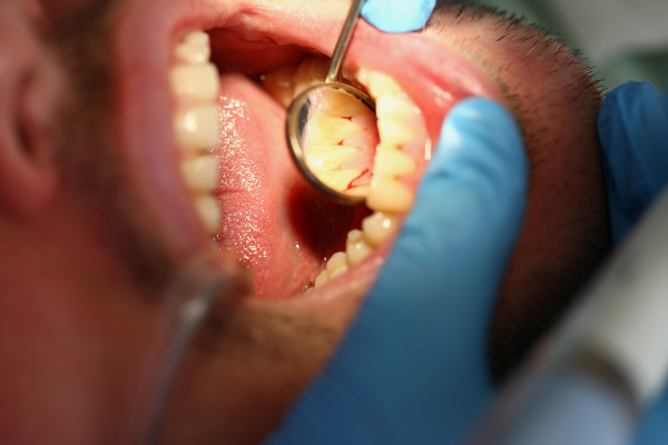 A man with bleeding gums in mid-stage periodontal disease.